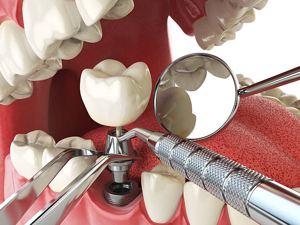 Best Emergency Tooth Extraction in Mount Plymouth, FL